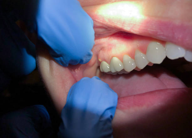 Best Emergency Dental Extractions in Hico, TX